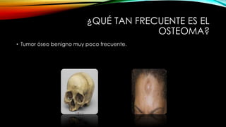 ¿QUÉ TAN FRECUENTE ES EL
OSTEOMA?
• Tumor óseo benigno muy poco frecuente.
 