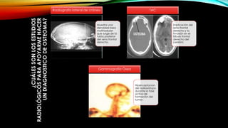 ¿CUÁLESSONLOSESTUDIOS
RADIOLÓGICOSPARAAPOYARMEHACER
UNDIAGNOSTICODEOSTEOMA?
Muestra una
densidad ósea
multinodular
que surge de la
tabla posterior
del seno frontal
derecho.
Radiografía lateral de cráneo
implicación del
seno frontal
derecho y la
invasión en el
lóbulo frontal
derecho del
cerebro.
TAC
Hipercaptacion
del radioisótopo
durante la fase
activa de
formación del
tumor.
Gammagrafía Ósea
 