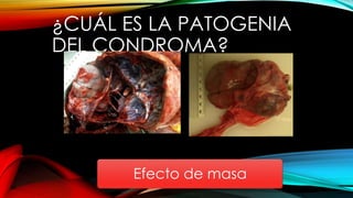 ¿CUÁL ES LA PATOGENIA
DEL CONDROMA?
Efecto de masa
 