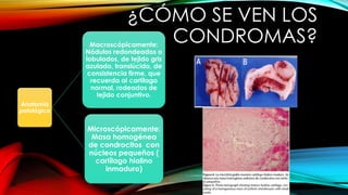 ¿CÓMO SE VEN LOS
CONDROMAS?
Anatomía
patológica
Macroscópicamente:
Nódulos redondeados o
lobulados, de tejido gris
azulado, translúcido, de
consistencia firme, que
recuerda al cartílago
normal, rodeados de
tejido conjuntivo.
Microscópicamente:
Masa homogénea
de condrocitos con
núcleos pequeños (
cartílago hialino
inmaduro)
 