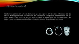 Los hemangiomas son tumores benignos que se originan en los vasos intrínsecos de los
tejidos. Histológicamente, se clasifican en cavernosos y capilares, dependiendo de los
vasos dominantes, aunque existen formas mixtas. Cuando afectan al tejido óseo, la
columna vertebral es su localización preferente, seguida de los huesos craneales
¿Qué es un hemangioma?
 