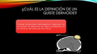 ¿CUÁL ES LA DEFINICIÓN DE UN
QUISTE DERMOIDE?
Tumores embrionarios disontogénicos originados por
la inclusión de elementos de origen ectodérmico en
el momento del cierre del tubo neural.
 