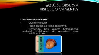 ¿QUÉ SE OBSERVA
HISTOLÓGICAMENTE?
• + Macroscópicamente:
• -Quiste unilocular
• -Pared gruesa de tejido conjuntivo.
• -Contenido: Casi siempre heterogéneo,
material proteináceo de queratina, pelo,
calcificaciones.
 