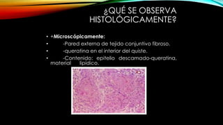 ¿QUÉ SE OBSERVA
HISTOLÓGICAMENTE?
• +Microscópicamente:
• -Pared externa de tejido conjuntivo fibroso.
• -queratina en el interior del quiste.
• -Contenido: epitelio descamado-queratina,
material lipídico.
 