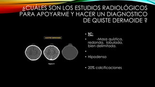 ¿CUÁLES SON LOS ESTUDIOS RADIOLÓGICOS
PARA APOYARME Y HACER UN DIAGNOSTICO
DE QUISTE DERMOIDE ?
• TC:
• -Masa quística,
redonda, lobulada,
bien delimitada.
•
• Hipodenso
• 20% calcificaciones
 