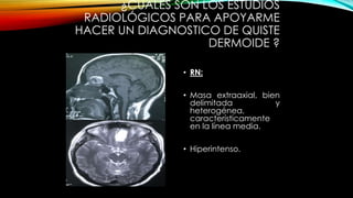 ¿CUÁLES SON LOS ESTUDIOS
RADIOLÓGICOS PARA APOYARME
HACER UN DIAGNOSTICO DE QUISTE
DERMOIDE ?
• RN:
• Masa extraaxial, bien
delimitada y
heterogénea,
característicamente
en la línea media.
• Hiperintenso.
 