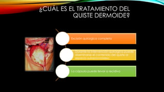 ¿CUÁL ES EL TRATAMIENTO DEL
QUISTE DERMOIDE?
Excisión quirúrgica completa
Durante la intervención quirúrgica puede
diseminarse el contenido del quiste al
espacio subaracnoideo.
La cápsula puede llevar a recidiva
 