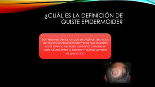 ¿CUÁL ES LA DEFINICIÓN DE
QUISTE EPIDERMOIDE?
Son lesiones benignas que se originan de restos
de tejidos epitelial ectodérmicos que quedan
en el sistema nervioso central al cerrarse el
tubo neural entre la tercera y quinta semana
de gestación.
 