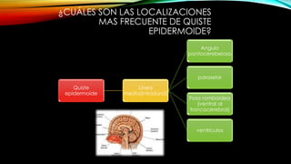 ¿CUÁLES SON LAS LOCALIZACIONES
MAS FRECUENTE DE QUISTE
EPIDERMOIDE?
Quiste
epidermoide
Línea
media(intradural)
Angulo
pontocerebeloso
paraselar
Fosa romboidea
(ventral al
troncocerebral)
ventrículos
 