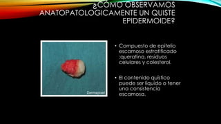 ¿CÓMO OBSERVAMOS
ANATOPATOLOGICAMENTE UN QUISTE
EPIDERMOIDE?
• Compuesto de epitelio
escamoso estratificado
:queratina, residuos
celulares y colesterol.
• El contenido quístico
puede ser líquido o tener
una consistencia
escamosa.
 