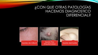¿CON QUE OTRAS PATOLOGÍAS
HACEMOS DIAGNOSTICO
DIFERENCIAL?
Quistes de millium
Quiste Pilar
(triquilemales)
Quiste dermoide
 