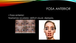 FOSA ANTERIOR
• Fosa anterior:
Trastornos oculares: déficit visual, diplopía,
 