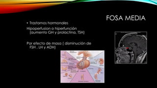 FOSA MEDIA
• Trastornos hormonales
Hipoperfusion o hiperfunción
(aumento GH y prolactina, TSH)
Por efecto de masa ( disminución de
FSH , LH y ADH)
 