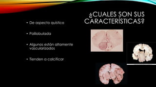 ¿CUALES SON SUS
CARACTERÍSTICAS?• De aspecto quístico
• Polilobulada
• Algunos están altamente
vascularizados
• Tienden a calcificar
 
