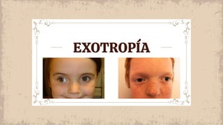 EXOTROPÍA
 