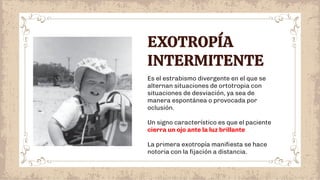 Es el estrabismo divergente en el que se
alternan situaciones de ortotropia con
situaciones de desviación, ya sea de
manera espontánea o provocada por
oclusión.
Un signo característico es que el paciente
cierra un ojo ante la luz brillante
La primera exotropía maniﬁesta se hace
notoria con la ﬁjación a distancia.
EXOTROPÍA
INTERMITENTE
 