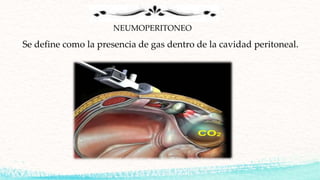 NEUMOPERITONEO
Se define como la presencia de gas dentro de la cavidad peritoneal.
 