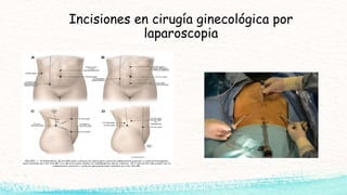 Incisiones en cirugía ginecológica por
laparoscopia
 