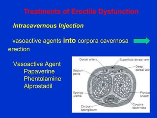 Erectile dysfunction | PPTX
