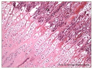 Zona de cartílago hipertrofiado