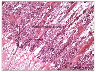 Zona de cartílago en erosión Osteoblastos Matriz cartilaginosa calcificada