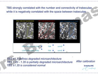 s
a

§  TBS strongly correlated with the number and connectivity of trabeculae,
while it is negatively correlated with the space between trabeculae

.
s
r

.
B

n
a
t
A

TBS ≤1.2 defines degraded microarchitecture
TBS 1.20 - 1.35 is partially degraded microarchitecture
TBS ≥1.35 is considered normal

After calibration

 