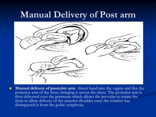 Erbs palsy | PPT