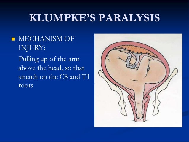 erb palsy