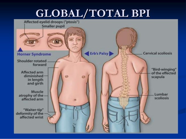 erbs palsy erbs palsy