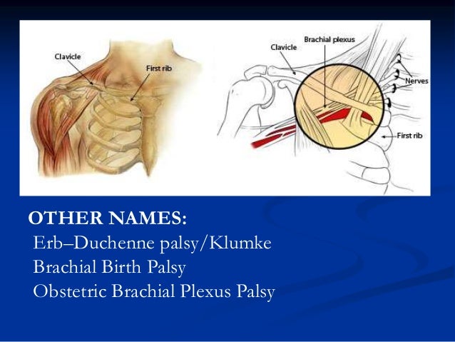 erb duchenne