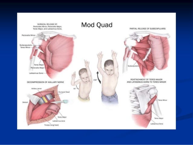 erbs palsy erb duchenne