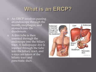 What is an ERCP?An ERCP involves passing an endoscope through the mouth, esophagus, and stomach into the duodenum. A thin tube is then inserted through the endoscope into the biliary tract. A radiopaque dye is injected through the tube into the biliary tract, and x-rays are taken of the biliary tract and pancreatic duct.