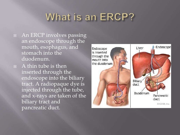 ERCP