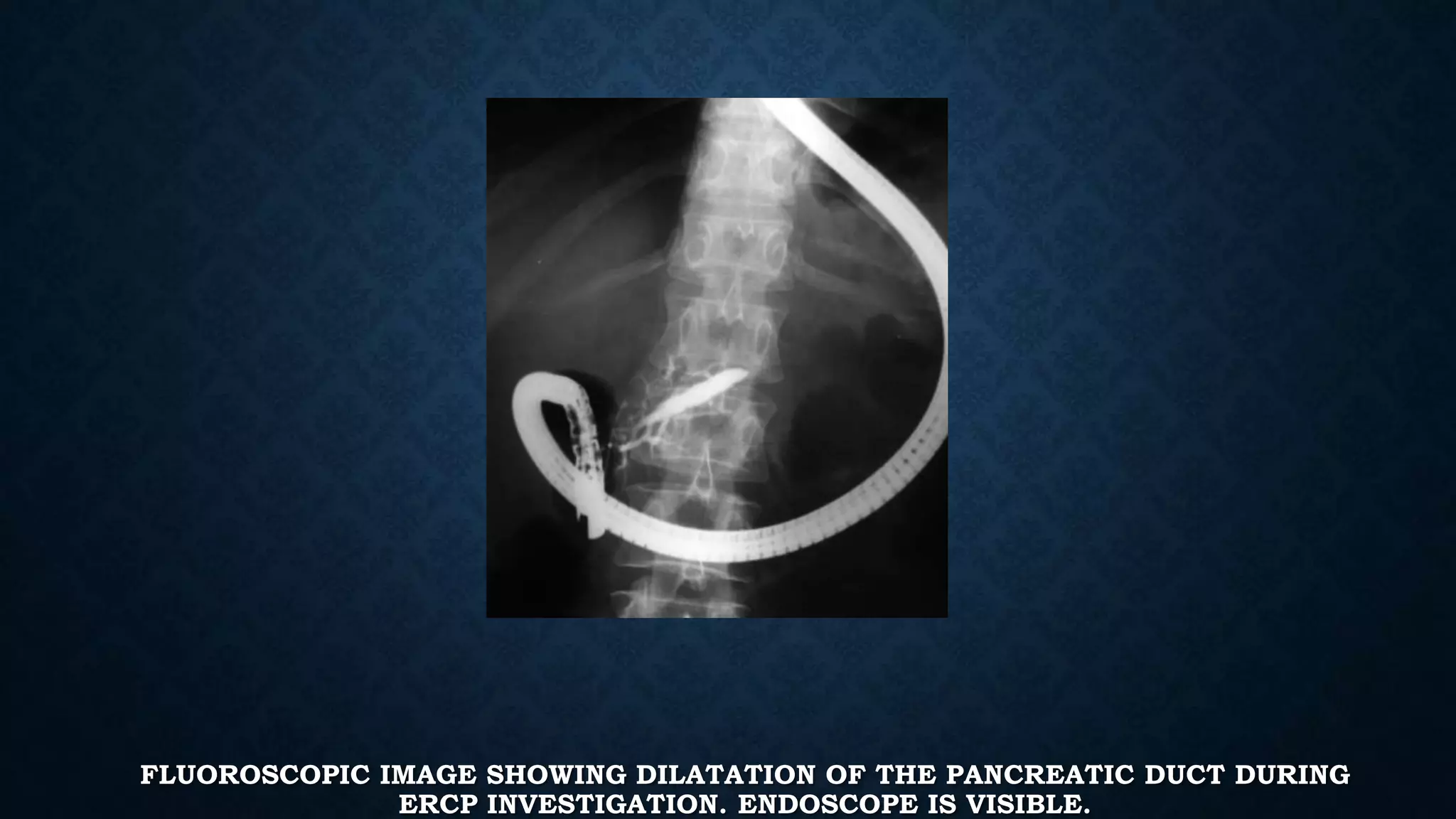 FLUOROSCOPIC IMAGE SHOWING DILATATION OF THE PANCREATIC DUCT DURING 
ERCP INVESTIGATION. ENDOSCOPE IS VISIBLE. 
 
