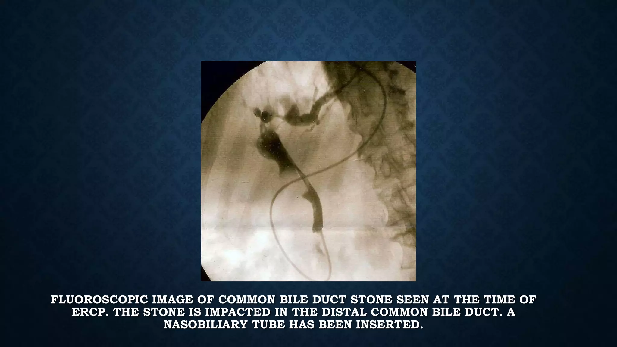 FLUOROSCOPIC IMAGE OF COMMON BILE DUCT STONE SEEN AT THE TIME OF 
ERCP. THE STONE IS IMPACTED IN THE DISTAL COMMON BILE DUCT. A 
NASOBILIARY TUBE HAS BEEN INSERTED. 
 