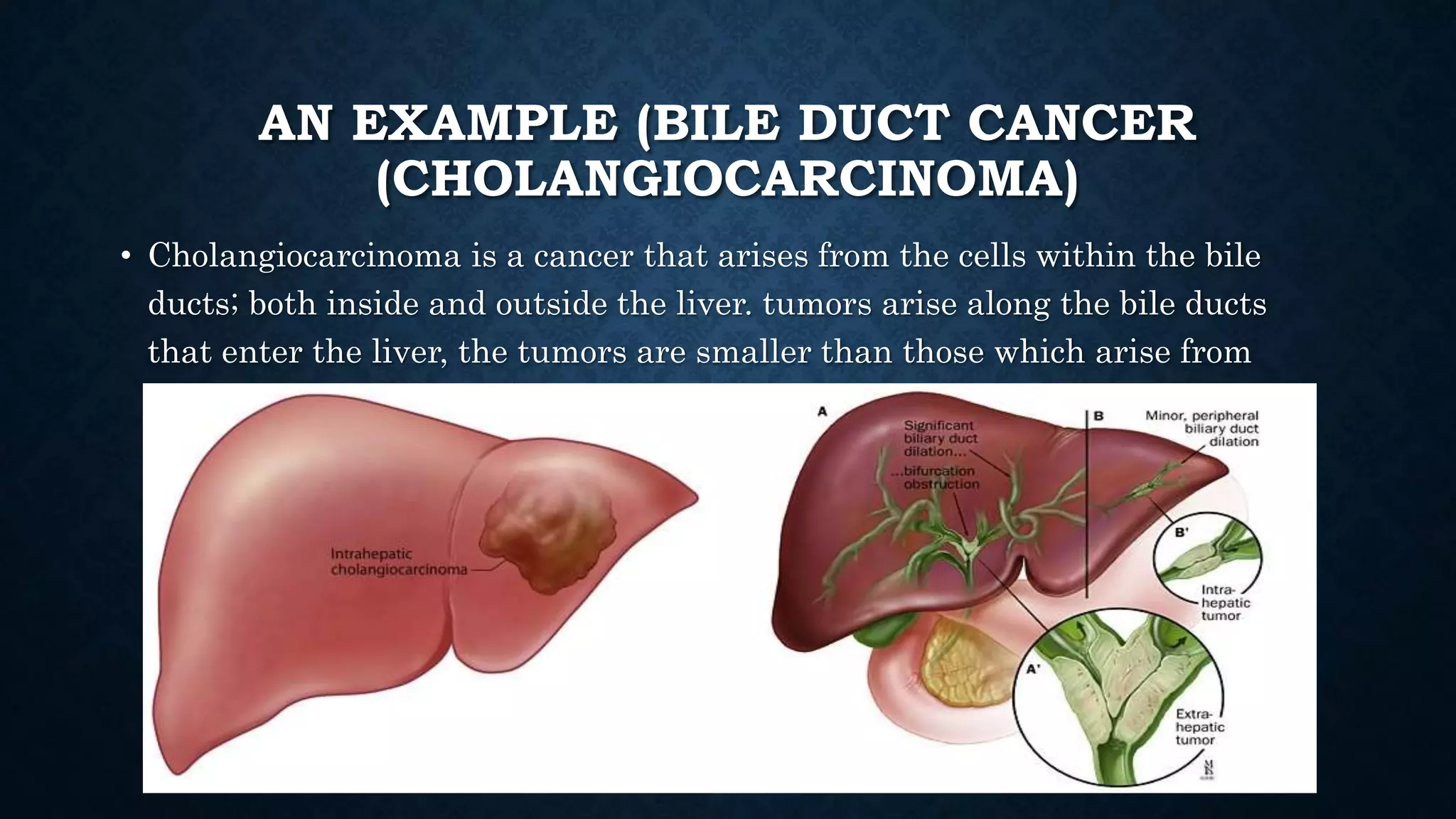 AN EXAMPLE (BILE DUCT CANCER 
(CHOLANGIOCARCINOMA) 
• Cholangiocarcinoma is a cancer that arises from the cells within the bile 
ducts; both inside and outside the liver. tumors arise along the bile ducts 
that enter the liver, the tumors are smaller than those which arise from 
within. 
 