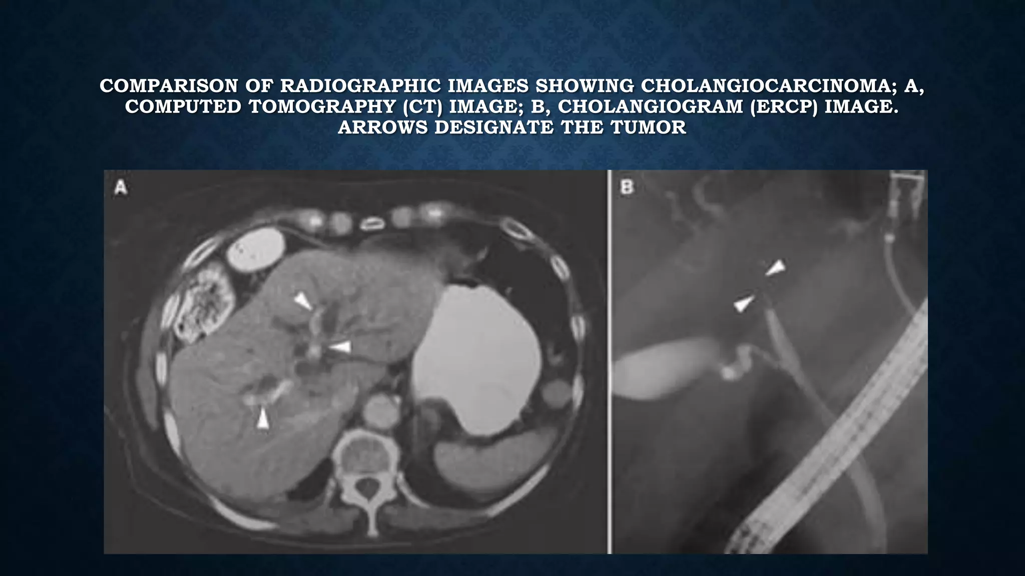 COMPARISON OF RADIOGRAPHIC IMAGES SHOWING CHOLANGIOCARCINOMA; A, 
COMPUTED TOMOGRAPHY (CT) IMAGE; B, CHOLANGIOGRAM (ERCP) IMAGE. 
ARROWS DESIGNATE THE TUMOR 
 