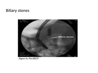 Biliary stones
 