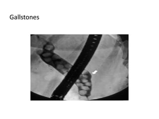 Gallstones
 