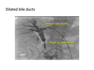 Dilated bile ducts
 