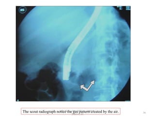 The scout radiograph notice the gas pattern created by the air. 36
GB Thapa, BScMIT.........ERCP
2068.01.05
 