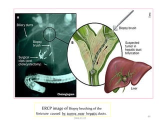 ERCP image of Biopsy brushing of the
Stricture caused by tumor near hepatic ducts.
49
GB Thapa, BScMIT.........ERCP
2068.01.05
 