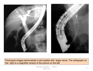 Fluorospot images demonstrate a wire basket with larger stone. The radiograph on
the right is a magnified version of the picture on the left.
53
GB Thapa, BScMIT.........ERCP
2068.01.05
 