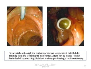 Pictures taken through the endoscope camera show a stent (left) & bile
draining from the stent (right). Sometimes a stent can be placed to help
drain the biliary ducts & gallbladder without performing a sphincteroctomy.
60
GB Thapa, BScMIT.........ERCP
2068.01.05
 