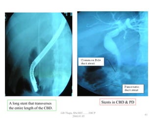 A long stent that transverses
the entire length of the CBD.
Stents in CBD & PD
61
GB Thapa, BScMIT.........ERCP
2068.01.05
 