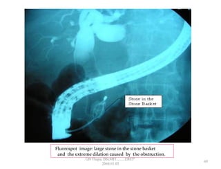 Fluorospot image: large stone in the stone basket
and the extreme dilation caused by the obstruction.
69
GB Thapa, BScMIT.........ERCP
2068.01.05
 