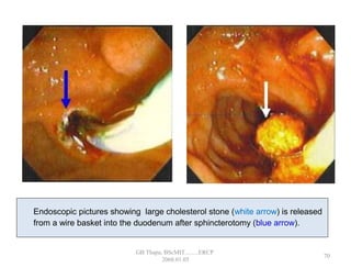 Endoscopic pictures showing large cholesterol stone (white arrow) is released
from a wire basket into the duodenum after sphincterotomy (blue arrow).
70
GB Thapa, BScMIT.........ERCP
2068.01.05
 