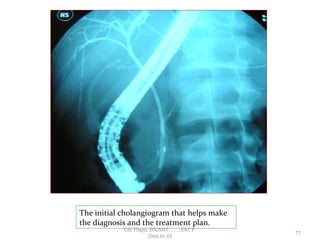The initial cholangiogram that helps make
the diagnosis and the treatment plan.
77
GB Thapa, BScMIT.........ERCP
2068.01.05
 