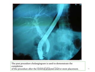 The post procedure cholangiogram is used to demonstrate the
completion
of the procedure after the removal of stones and/or stent placement. 78
GB Thapa, BScMIT.........ERCP
2068.01.05
 