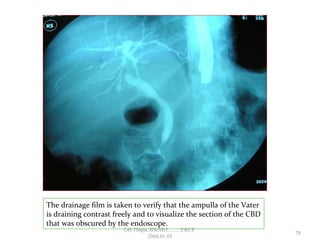 The drainage film is taken to verify that the ampulla of the Vater
is draining contrast freely and to visualize the section of the CBD
that was obscured by the endoscope.
79
GB Thapa, BScMIT.........ERCP
2068.01.05
 